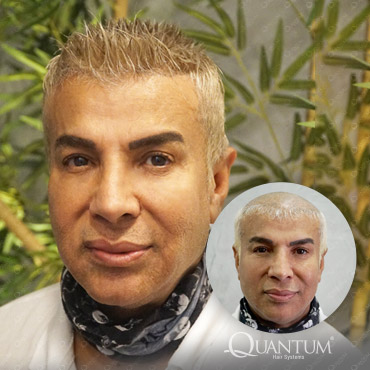 protez saç öncesi ve sonrası